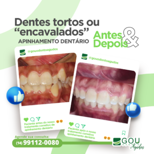 dentes tortos